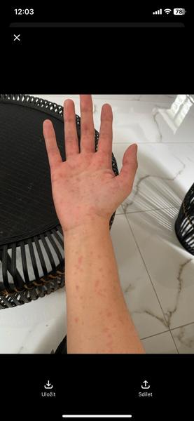 Nevysvětlitelné otoky a tečky na těle. Co to může být?