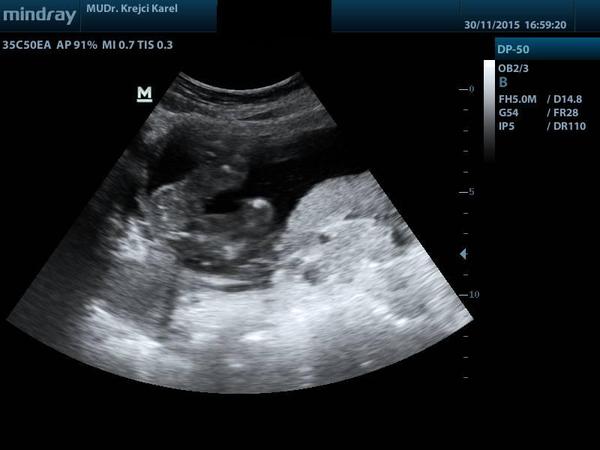 Je na ultrazvuku holčička?