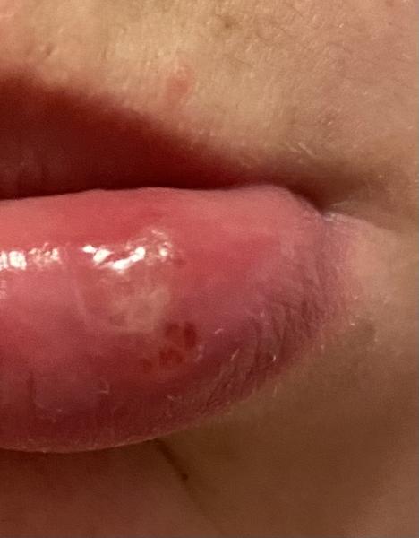 Jak rozeznat opar od aftu?