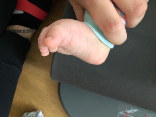 Zatnuté prstíky. Je to normální?