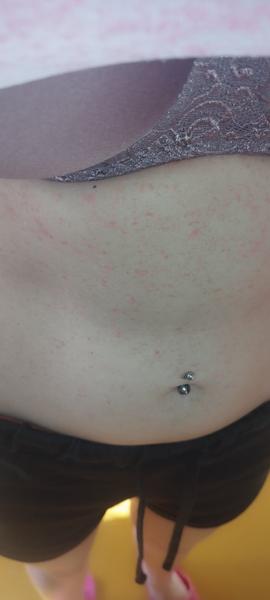 Co způsobuje vyrážku a jaké léky nepomáhají?