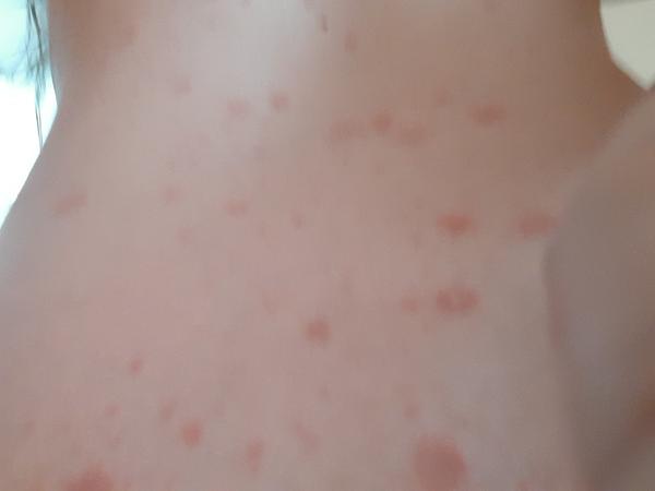 Zkušenosti s pytrisia rosea Gibert. Pomůže rakytníkový olej?