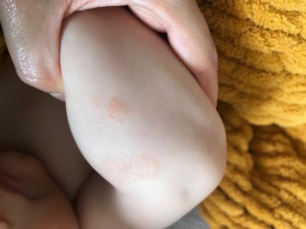 Vyrážka u ročního miminka. Co by to mohlo být?