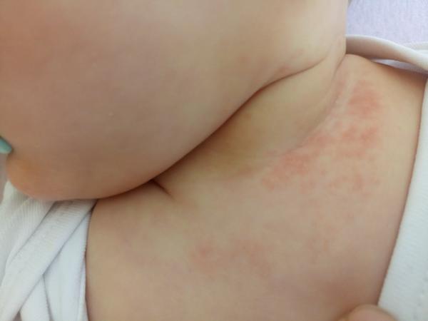 Poznáte prosím tuhle vyrážku?