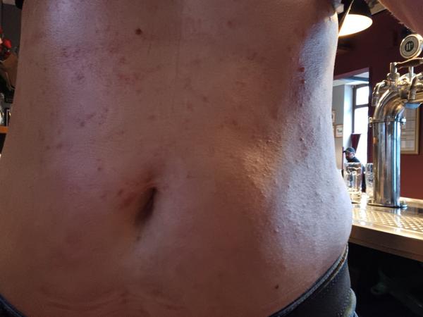 Co dělat při svědivé vyrážce před vyšetřením na alergologii?