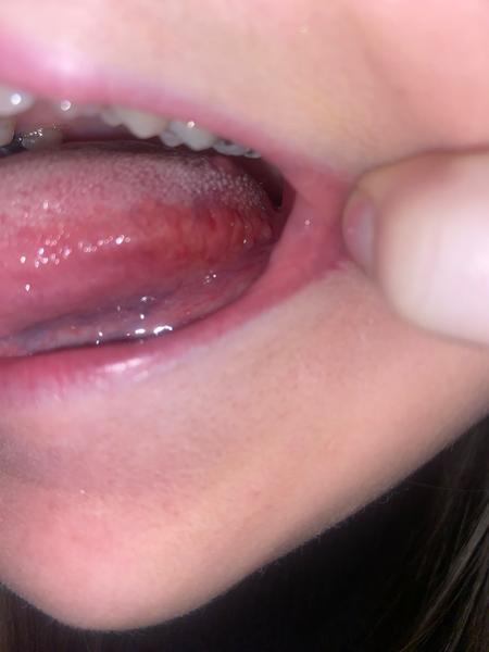 Hrbolky na jazyku. Je to normální?