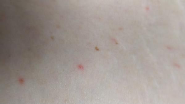 Vyrážka na břiše. Co by to mohlo být?