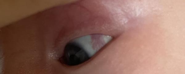 Červený flek v oku u miminka: Prasklá žilka?