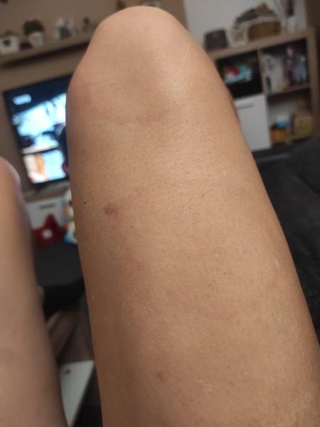 Jsou kruhy na kůži po klíštěti příznakem boreliózy?