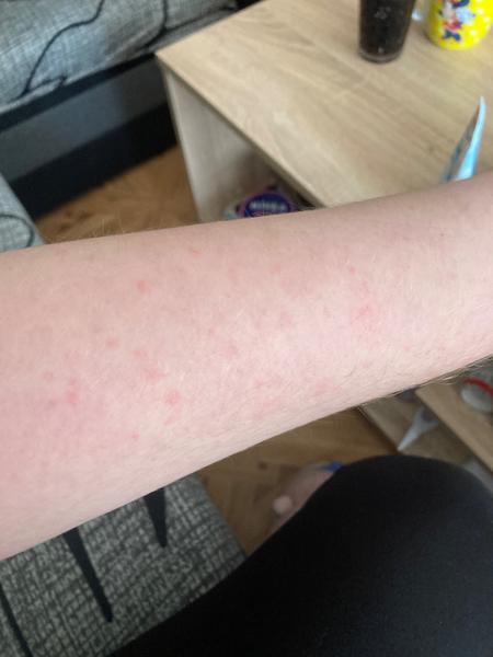 Horečka a vyrážka po porodu. Jaké mohou být příčiny?