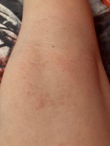 Je to vyrážka pod kolenem nebo svrab?