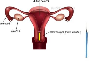 Změny na čípku, když jsou léze lokalizovány směrem do děložního hrdla