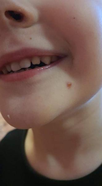 Horečky, vyrážka a bolest hlavy: Co to může být?