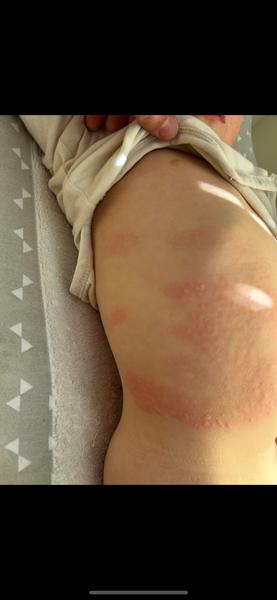 Neustálé objevování pupínků u dětí. Co může pomoci?