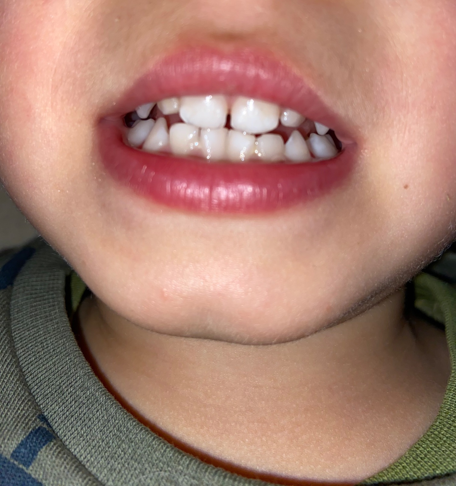 Medové zuby? Modrý koník