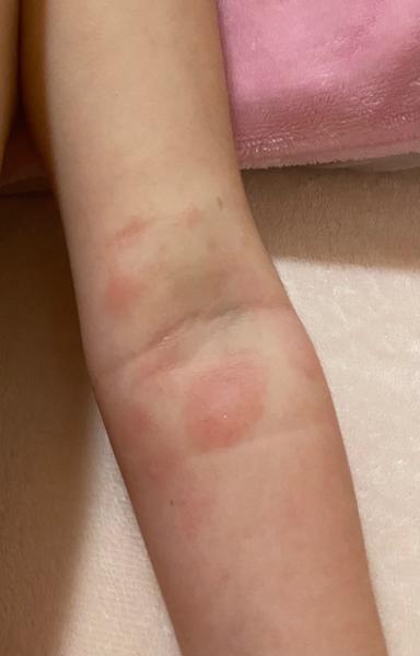 Je to atopický ekzém, nebo něco jiného? Zkušenosti rodičů