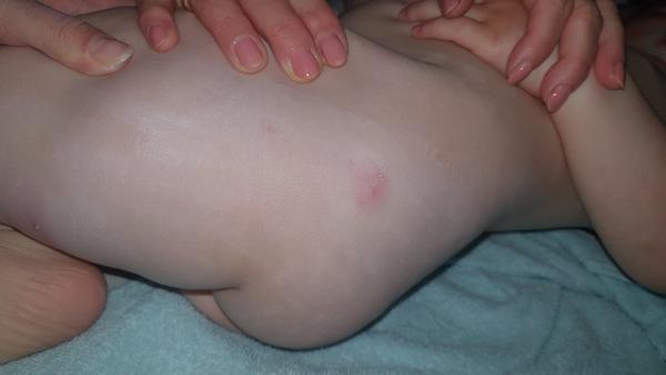 Vyrážka, infekce nebo neštovice. Poradíte, prosím, co by to mohlo být?