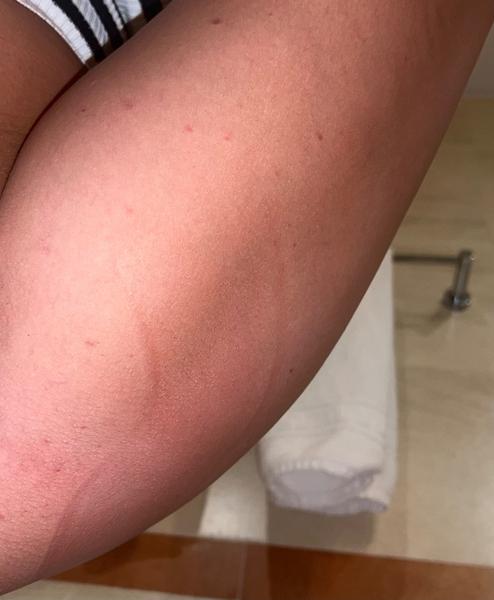 Co jsou červené pupínky na nohou?