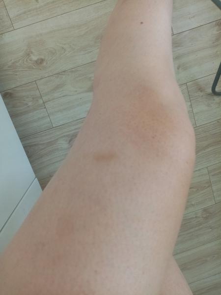 Modřiny na dolních končetinách - z čeho můžou být?