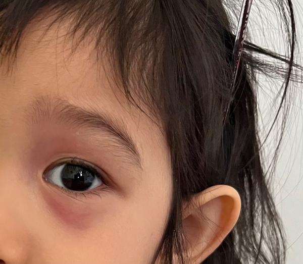 Levý otok víčka u dítěte: Jaké jsou zkušenosti?