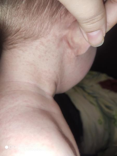 Šestá nemoc nebo spalničky - bojím se. Já měly Vaše děti vyrážky?