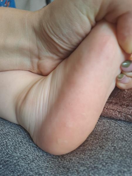 Puchýřky na nohou po sedmé nemoci: Co dělat?