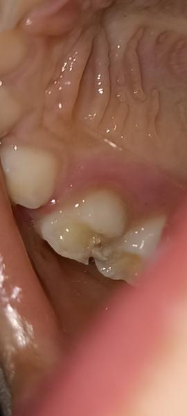 Je kaz na mléčném zubu u šestiletého dítěte?