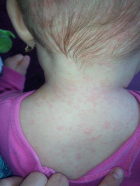 Exém, nebo vyrážka - prosím radu