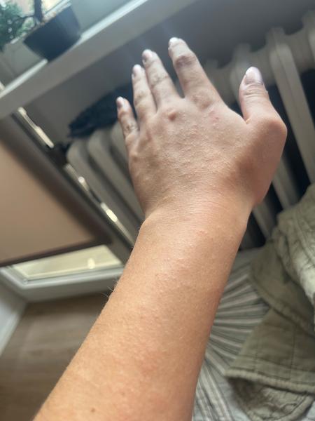 Jak rozeznat svrab od jiných kožních problémů?