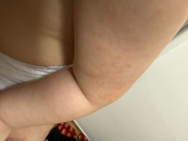 Suchá nažloutlá vyrážka u dítěte. Je to atopický ekzém?