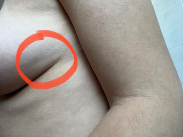 Mám se obávat důlku v prsu? Kdy jít k lékaři?