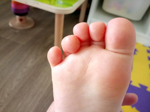 Deformace prstu. Jak se řeší?