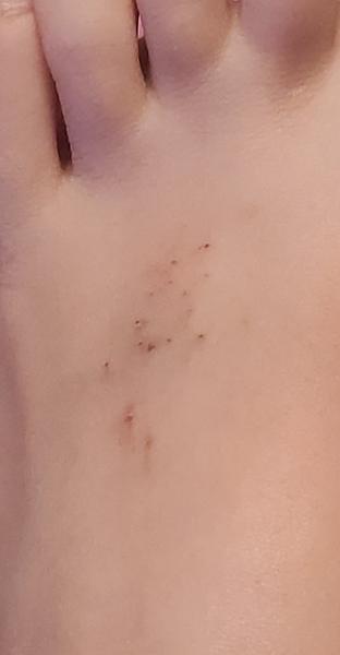 Zahadna vyrážka/ štipance