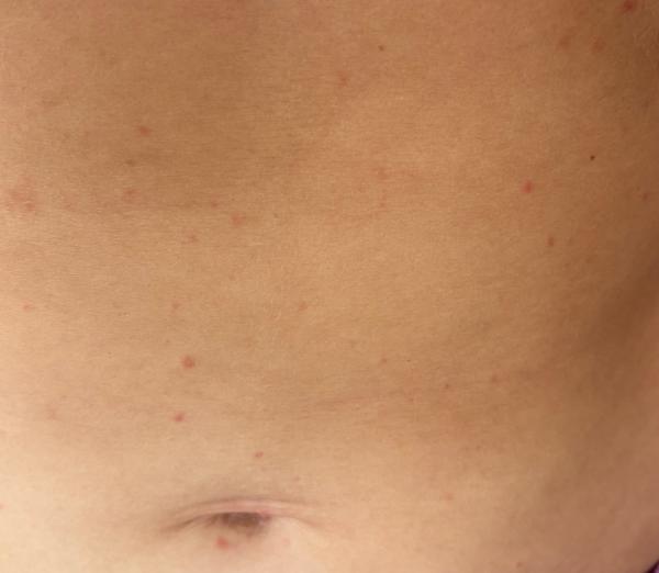 Červené fleky na těle. Co to může být?