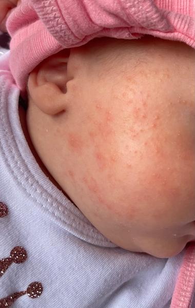 Potničky nebo novorozenecké akné? Jak je poznat?