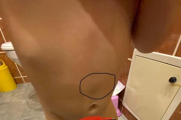 Boulička nad pupíkem. Jedná se o kýlu, nebo to má souvislost s diagnostikovanou diastázou?