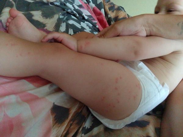 Co může způsobit nesvědivé pupínky na kůži dítěte?