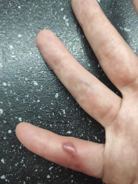 Vyrážka na malíčku - velké bolestivé puchýře. Prosím, pomůžete?