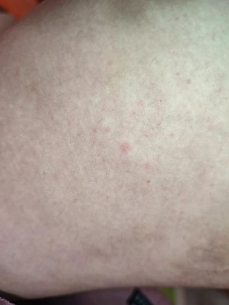 Co způsobuje vyrážku na stehnech a břichu?