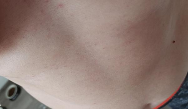 Vyrážka. Setkaly jste se s tím?