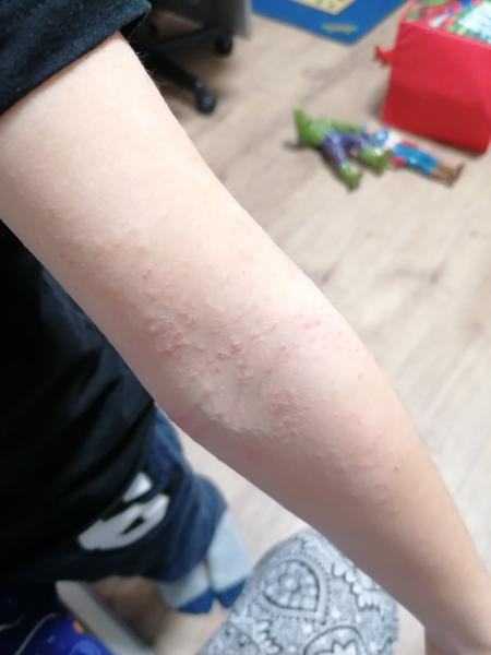 Může kiwi způsobit vyrážku u dětí?