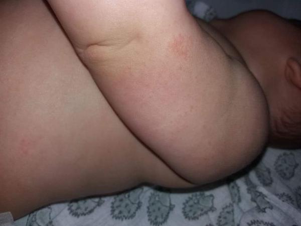 Ekzém. Co by pomohlo?