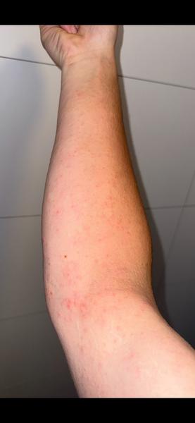 Vyrážka. Co to může být a jak to léčit?