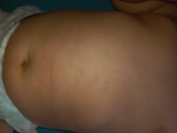 Červené malinké skvrny na zádech a bříšku. Jsou to potničky?