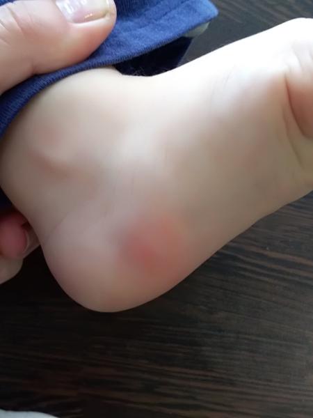 Vyrážka (ruce, nohy). Máte zkušenosti?