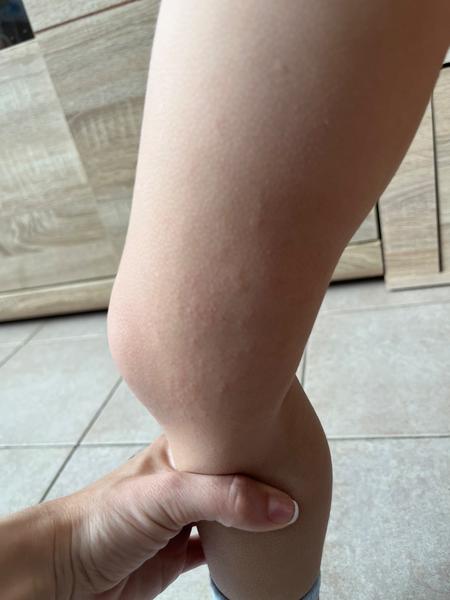 Malé pupínky po celém těle u dítěte. Co dělat?