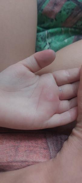 Má syn štípanec na ruce nebo něco jiného?