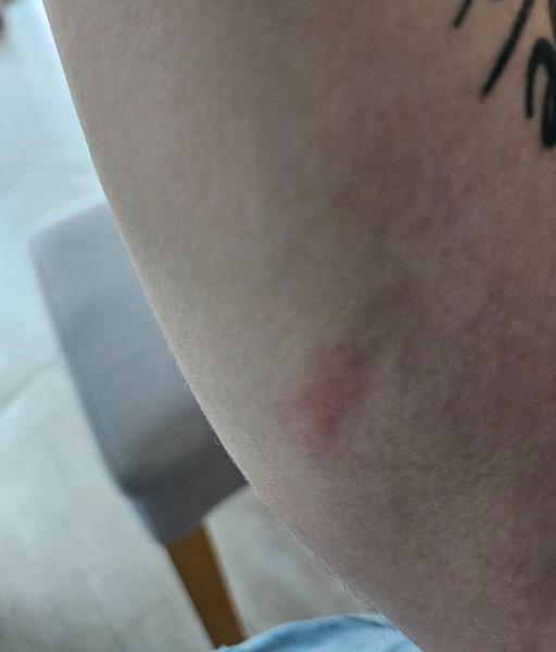 Co způsobilo velkou vyrážku na ruce?