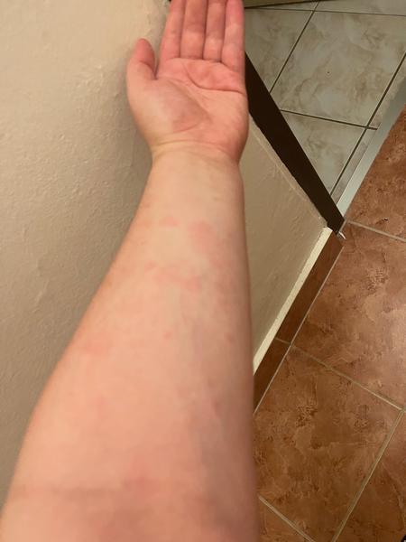 Alergie nebo kopřivka?