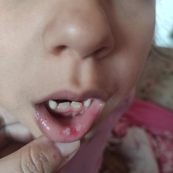 Je moučnivka důvod, proč držet dítě doma ze školky?